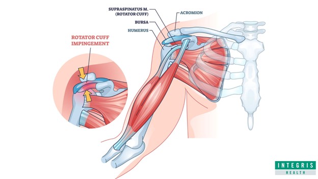 Rotator cuff graphic