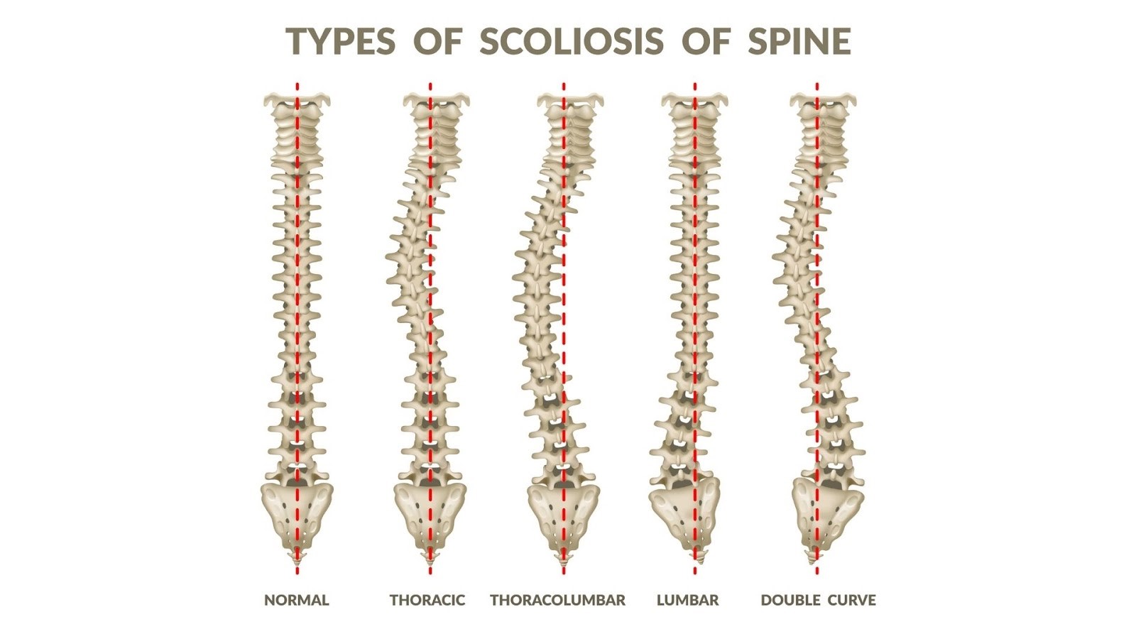 Scoliosis Spine